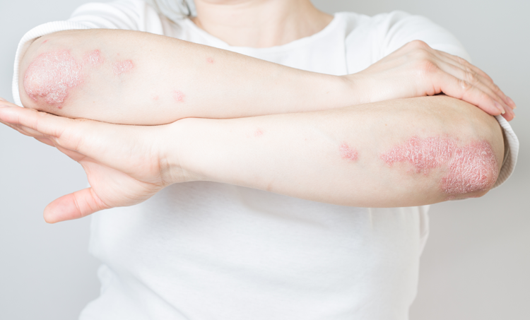 Lavas essentiële olie bij psoriasis