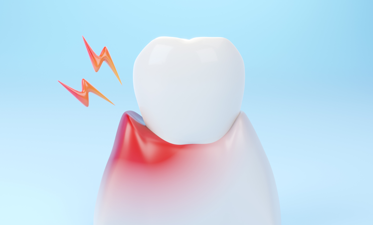 Associatie periodontitis en insulineresistentie